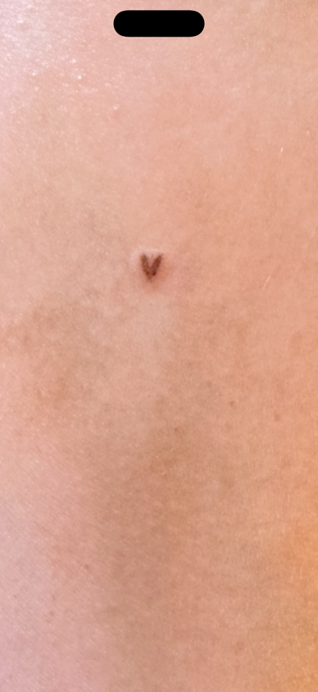 Heart Freckles