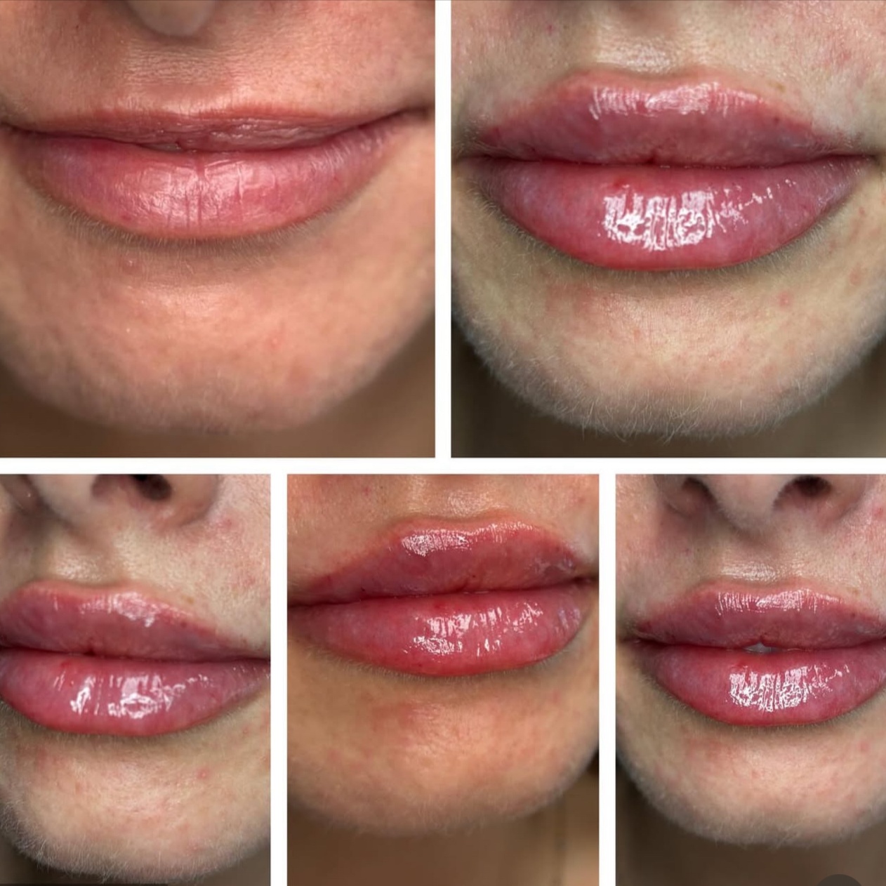 💉 Injection Day Consultation at lillyrosebeauty in Murrieta, CA