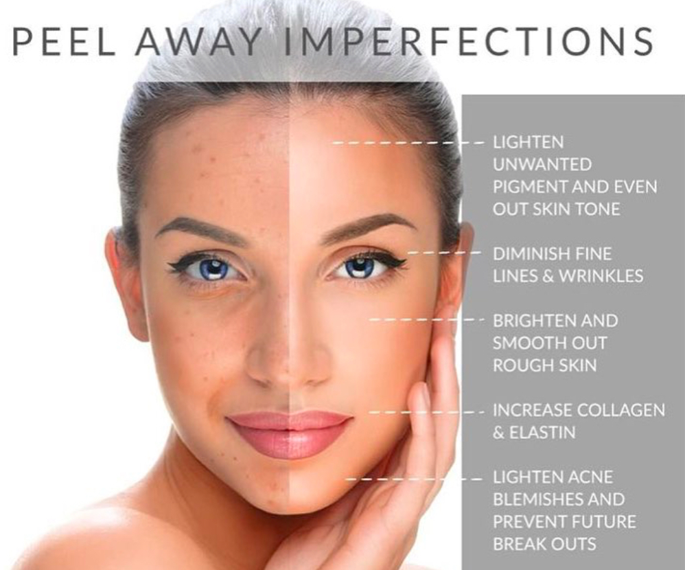 TCA Resurfacing Peel