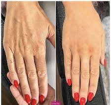 Hands Treatments