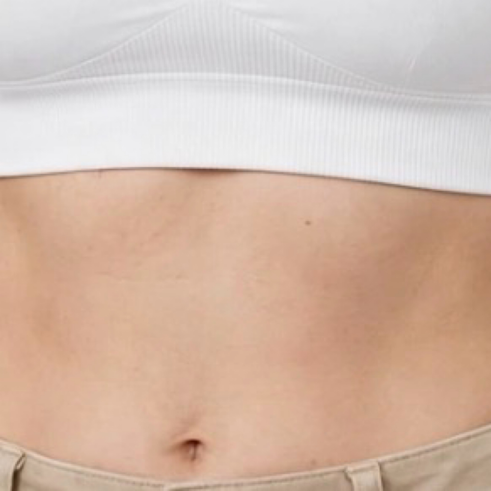 Stomach Strip I 6 Sessions at EverBeauty Laser & Aesthetics in Argyle, TX