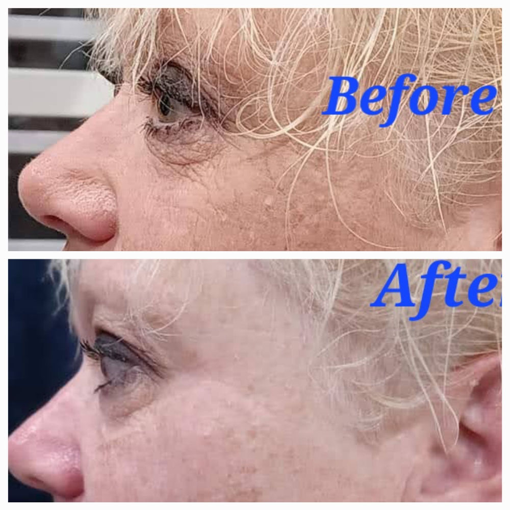 Collagen Eye Treatment
