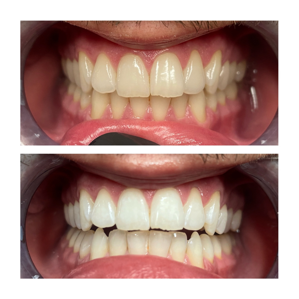 20 Minute Teeth Whitening(touch up)