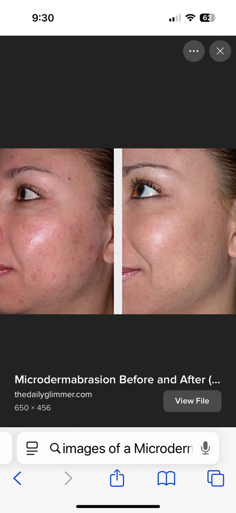 Microdermabrasion Treatment