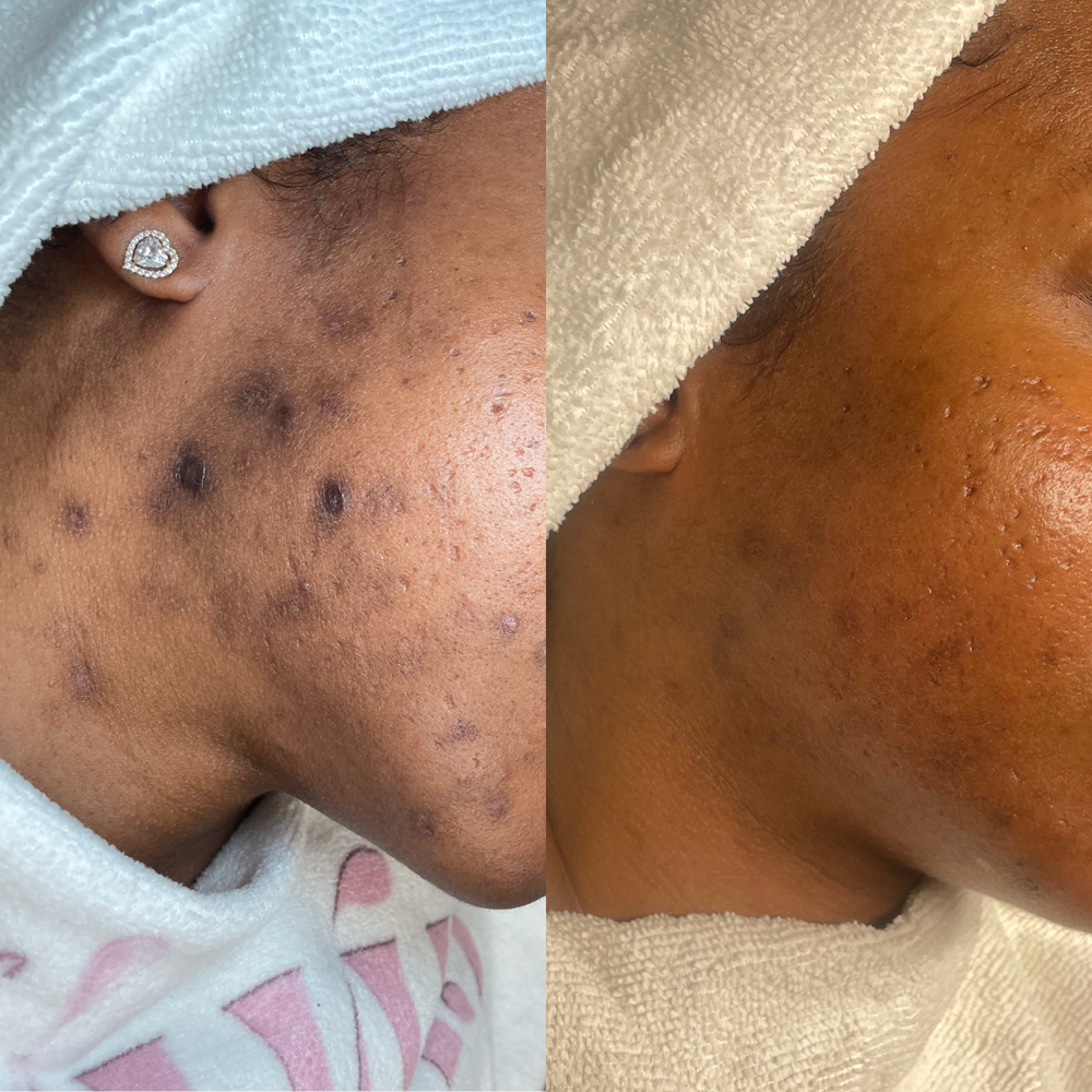 Customized Chemical Peel