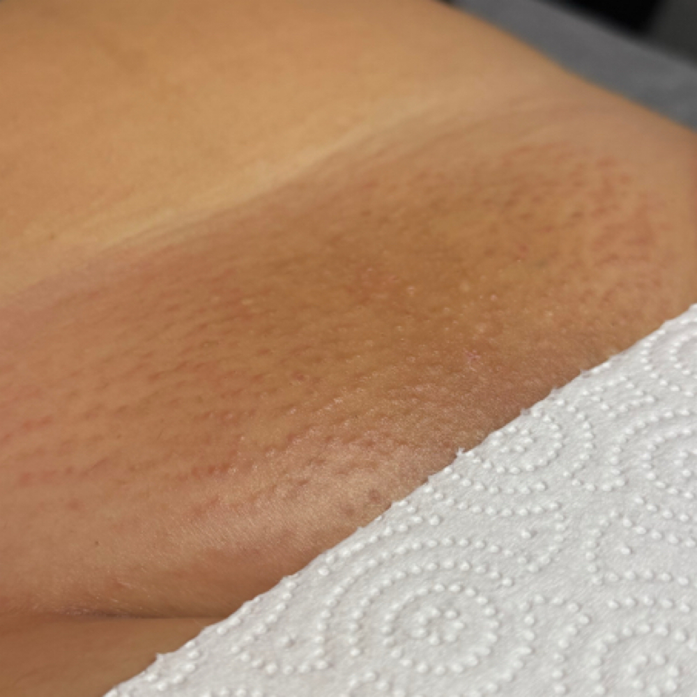 Routine Brazilian (V) at LaLa Esthetics in Los Alamitos, CA