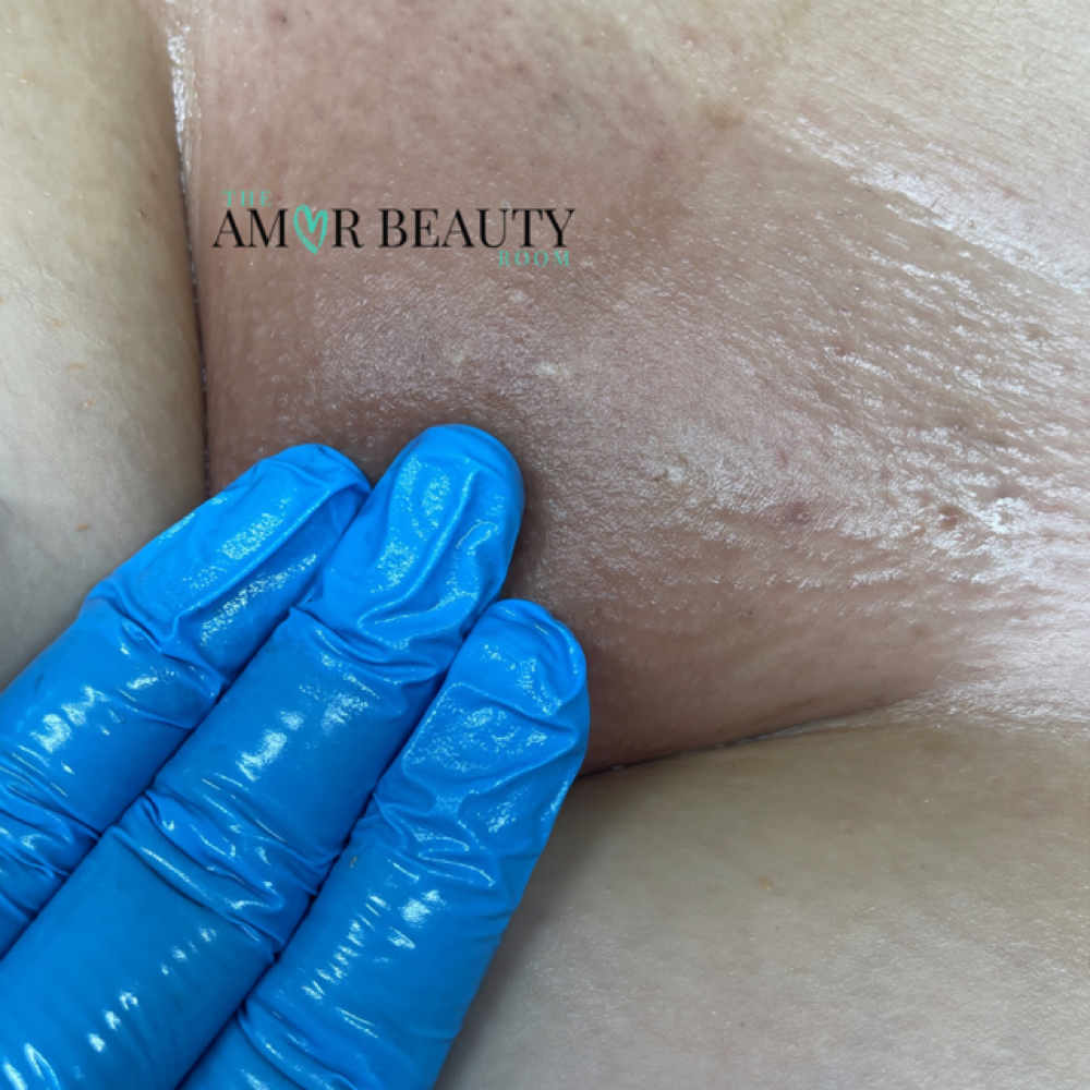 Bare Brazilian + Jelly Mask at The Amor Beauty Room in Fort Worth, TX