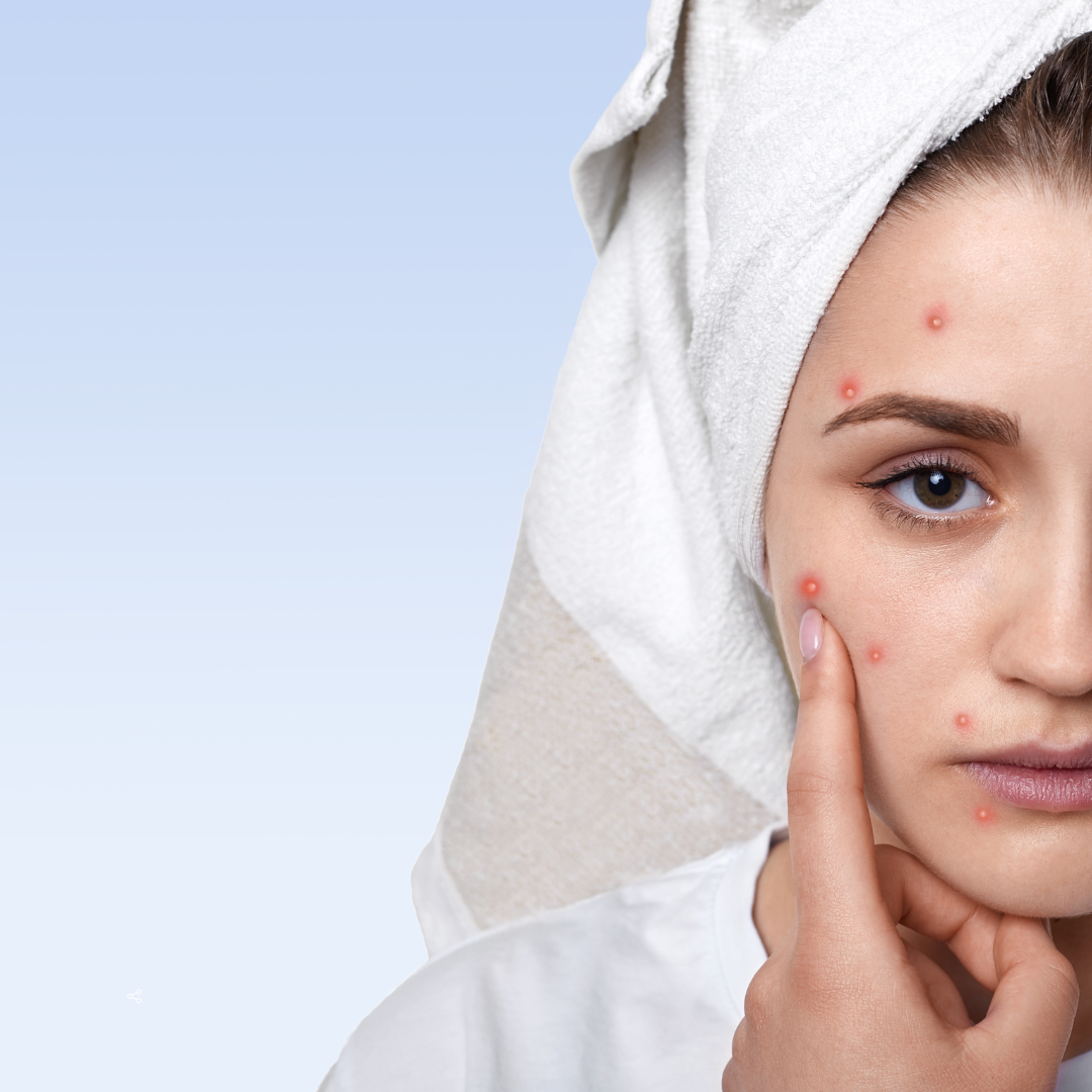 "The Blemish Buster"