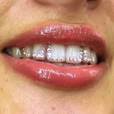 Tag Team Whitening