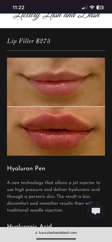 Needle- Less Lip Filler 2ml