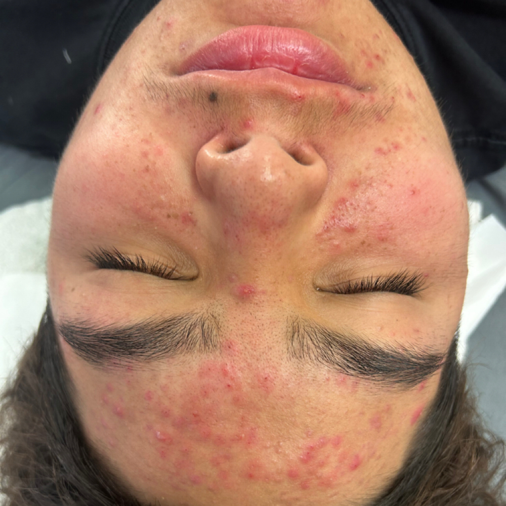 Acne clearing facial at Rose & Blush Esthetics in Lytle, TX