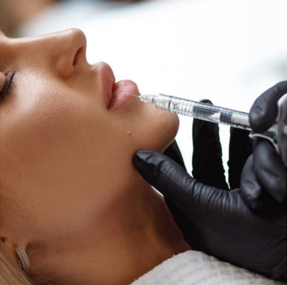 Lip Filler (Full Syringe) at ReGenerations Medi Spa in Radcliff, KY