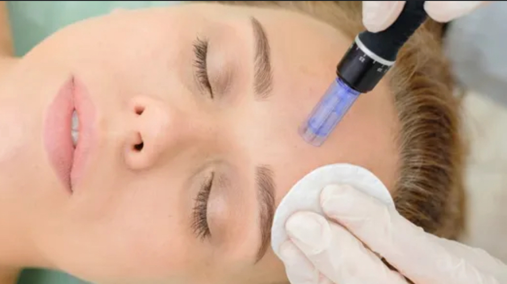 Microneedling