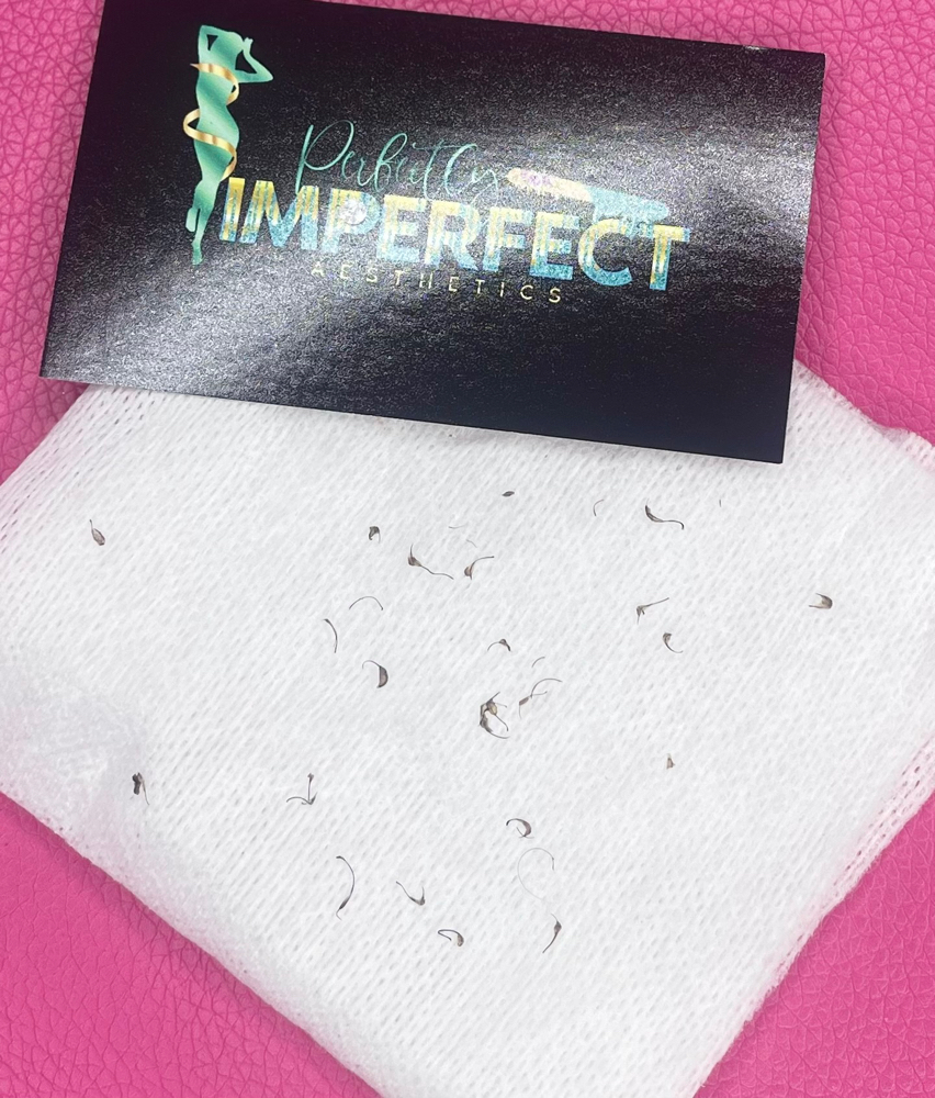 Ingrown Extractions