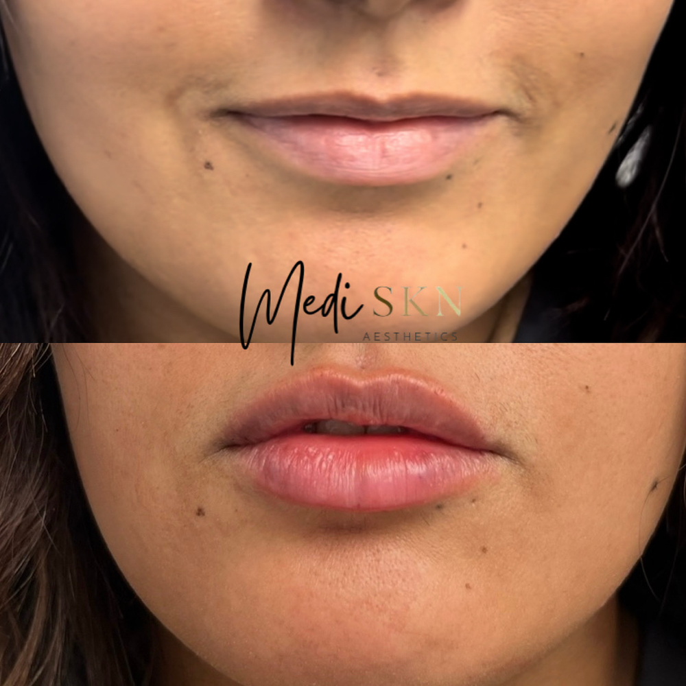 Lip Filler