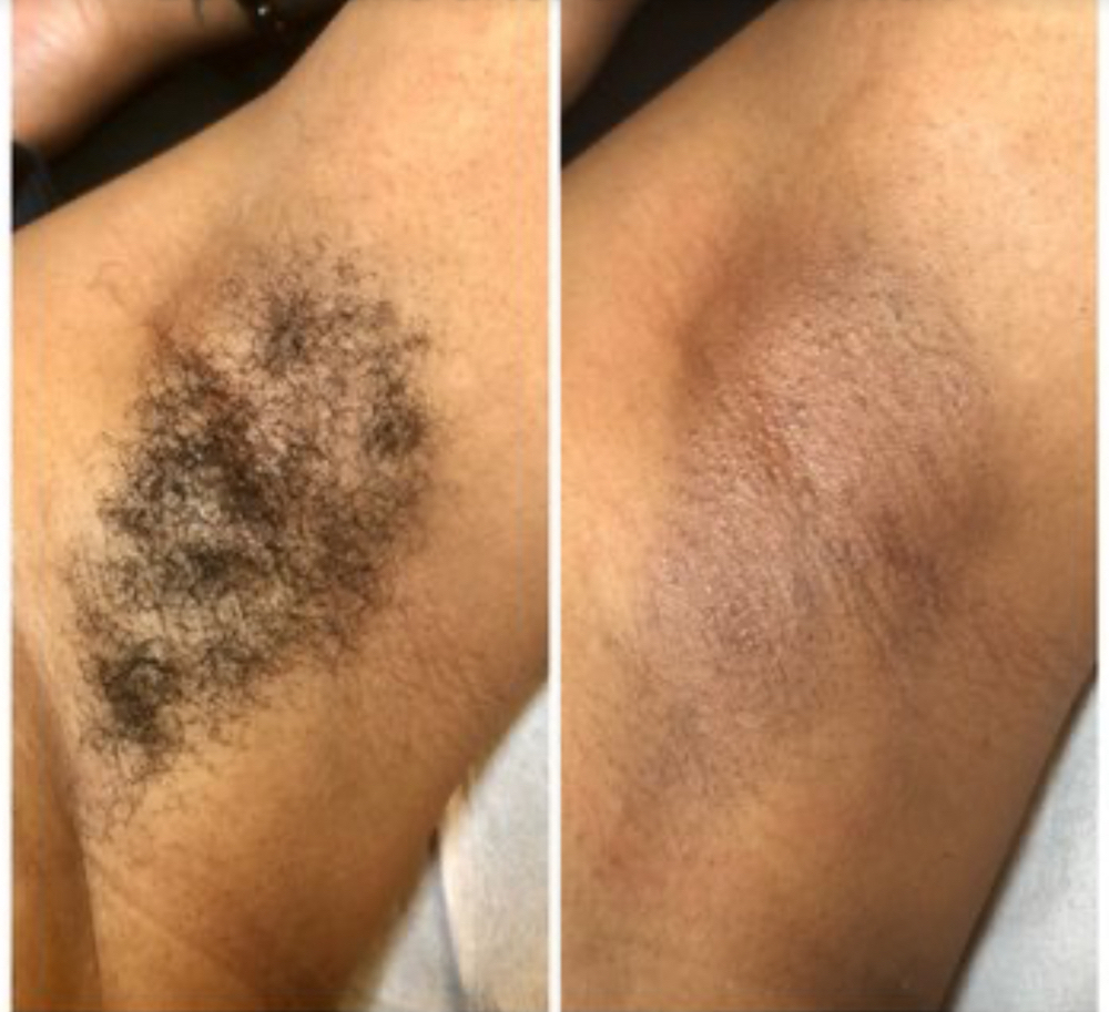 Under Arm Wax at Dio Artistry in Louisville, KY