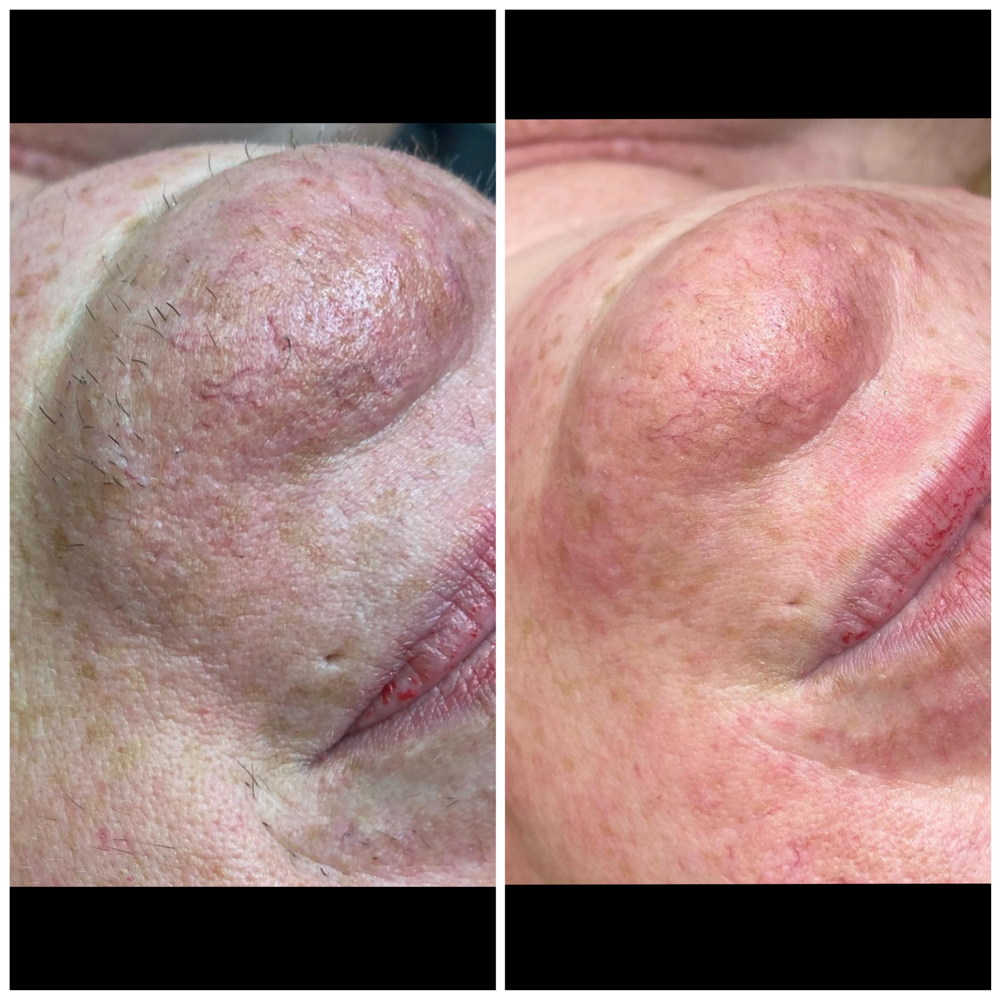 Chin Wax