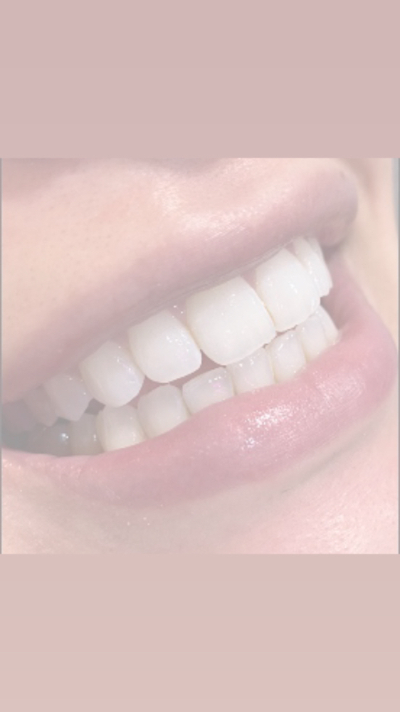 Teeth Whitening Touch Up