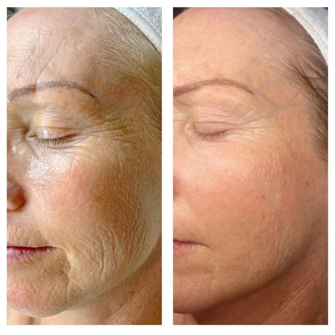 Face Microchanneling + Stem Cells