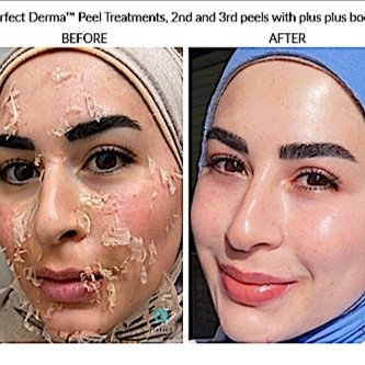 The Perfect Derma Peel at Skin By Aisha in Winter Park, FL