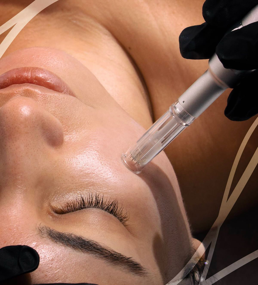 Nanoneedling With Serum Infusion at Ale Esthetics Studio in Selden, NY