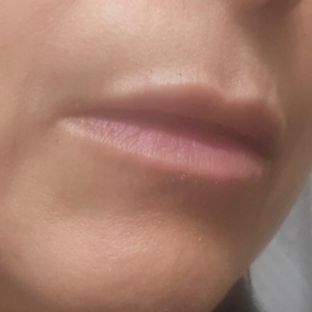 Lip Filler 1ML Elasty at Pure Bliss Studios in Fort worth, TX