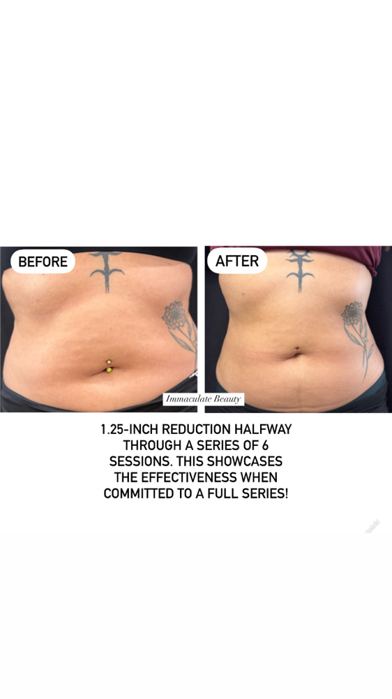 Body Sculpting- Stomach & Hips