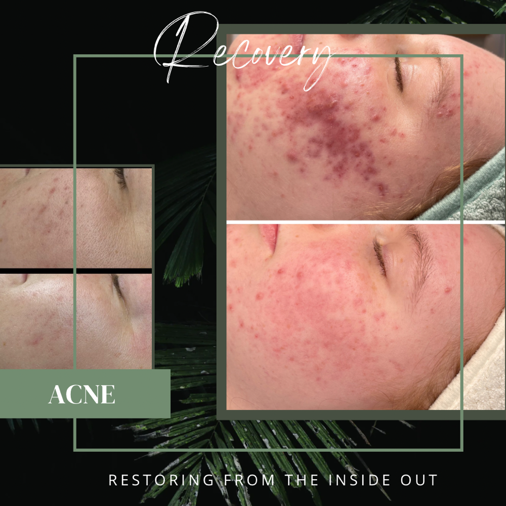 Recovery (Acne)