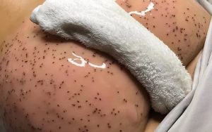 Bum Facial W/ Microdermabrasion