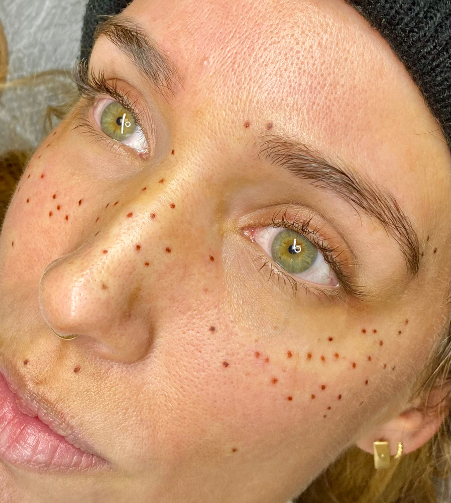 Freckles