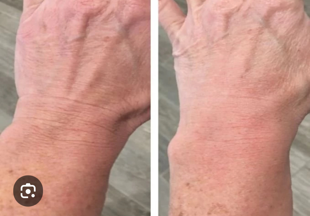 Cryo T Hand Rejuvenate