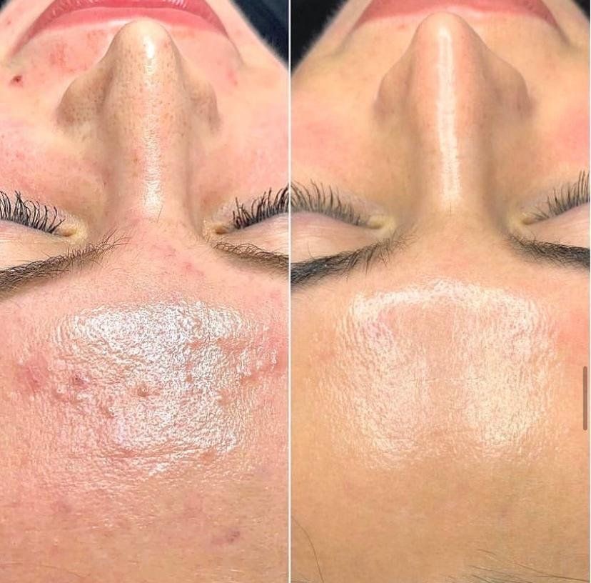 Chemical Peel