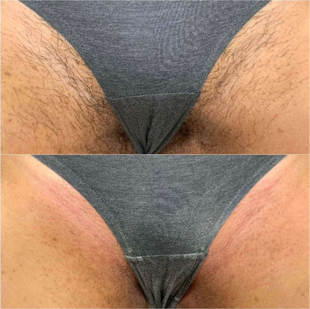 Bikini Wax