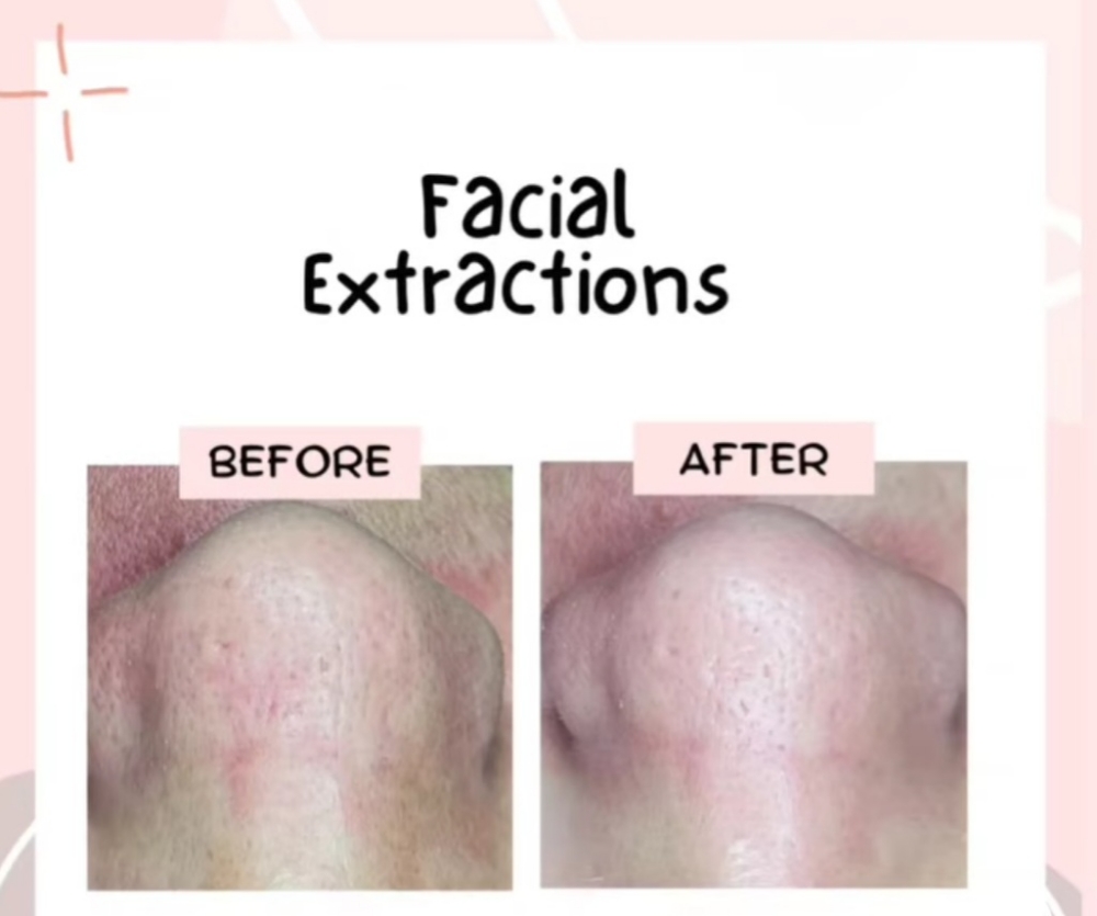 Facial Extractions