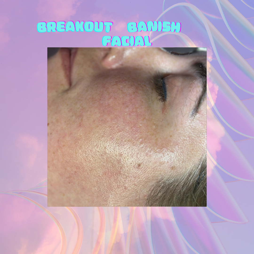 👹 The Breakout Banish Facial