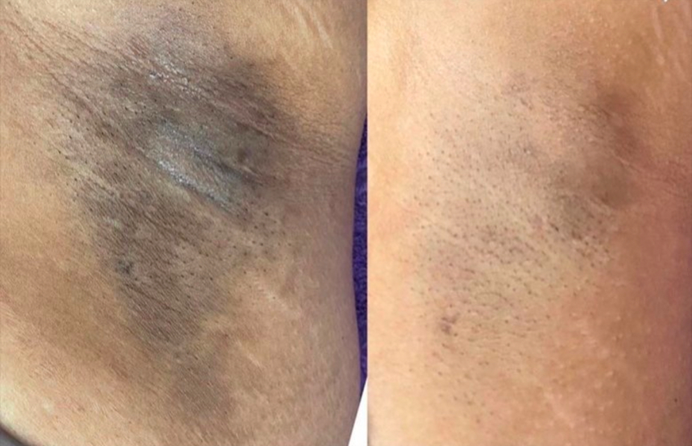 Underarm Bleaching