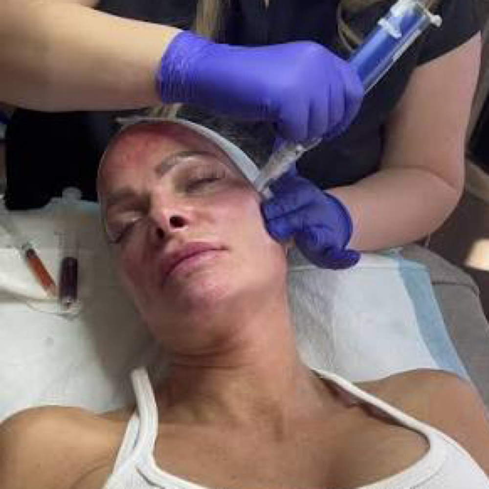 Prp Microneedling Face Only at All Aesthetics Kare in Upland, CA