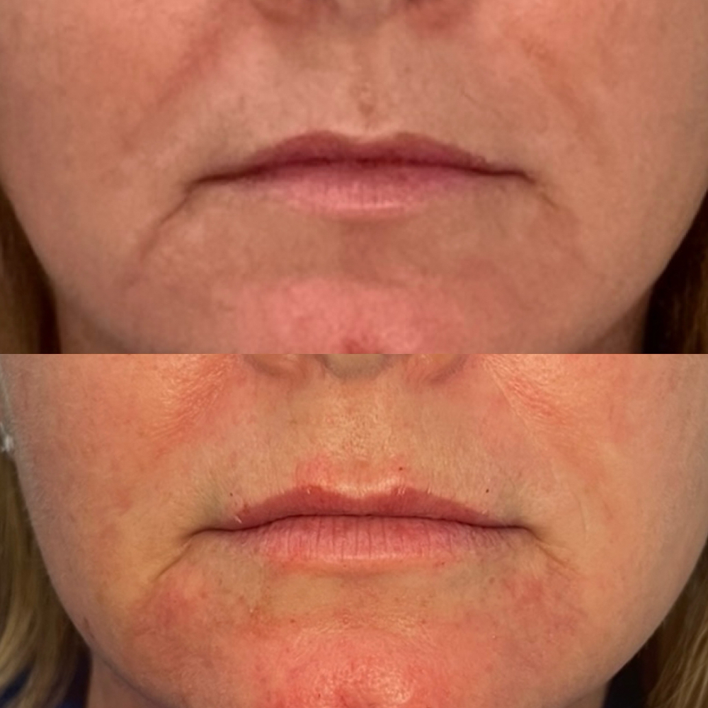 Botox - DAO (Lower Smile Lines)