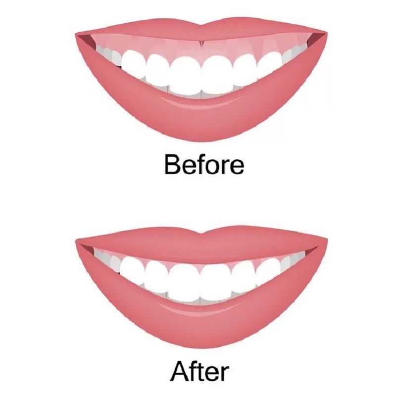 Lip Flip/Gummy Smile $75-100