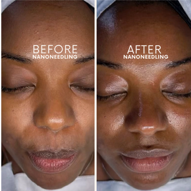 Nanoneedling Facial at Glow Aesthetics Studio in Atlanta, GA