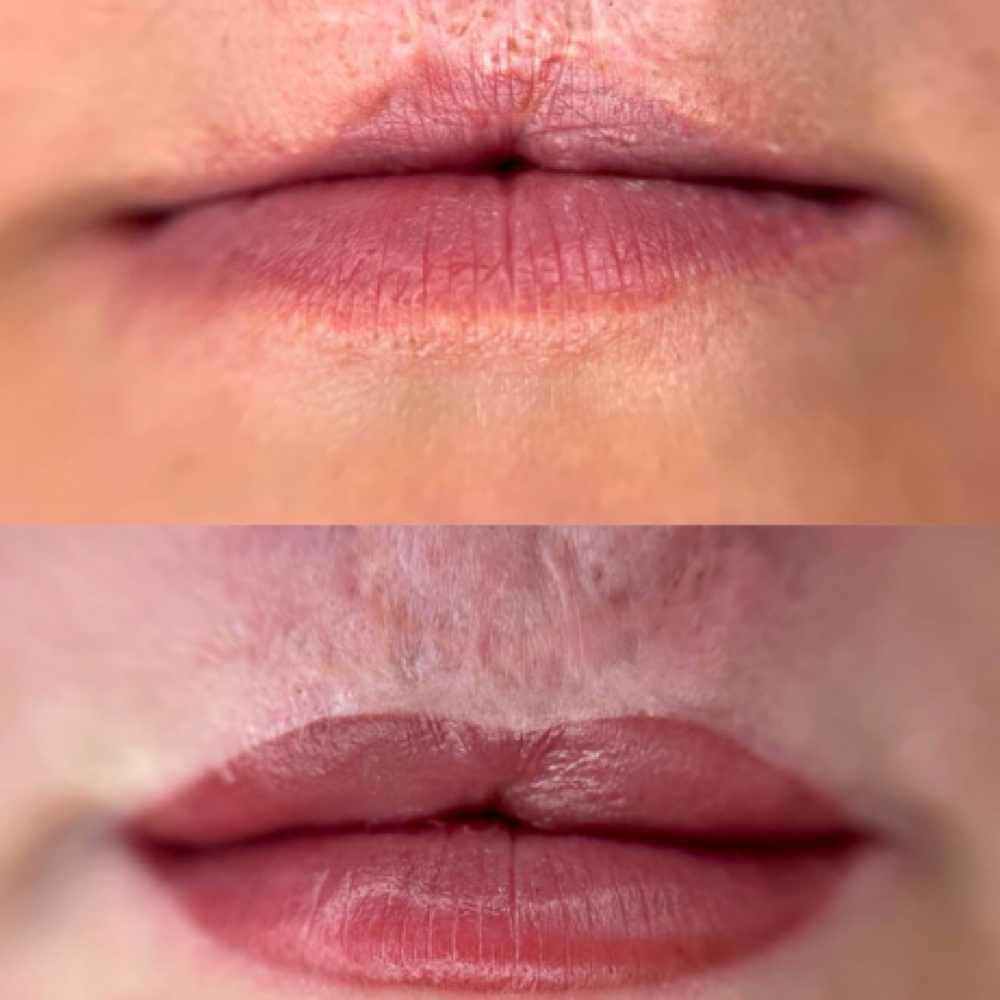 Reconstructive Lip Blush (post surg at INKD Brow Studio in Oklahoma City, OK