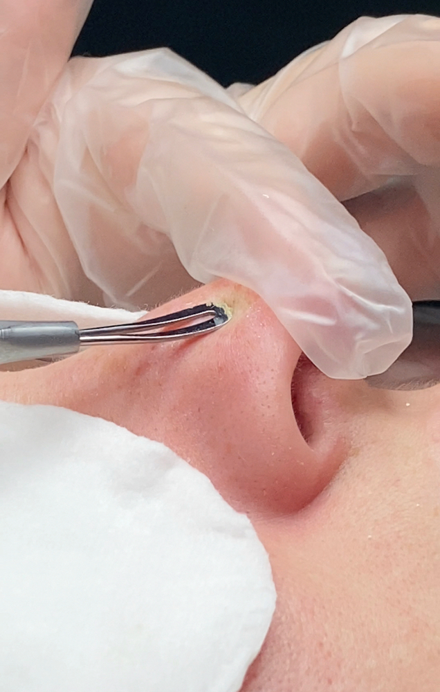 Skin Clearing Facial