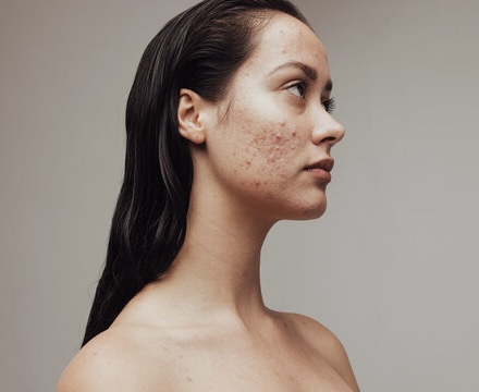 Acne Clearing Facial