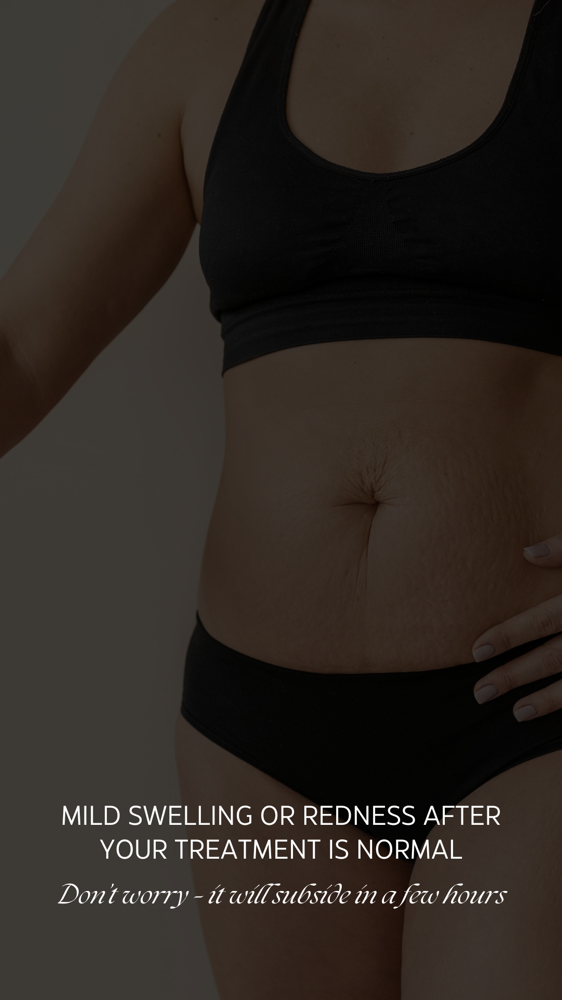 Fat Dissolve Injections/Contouring