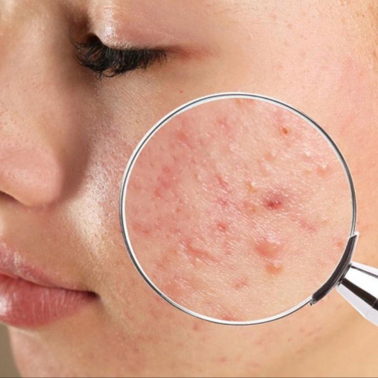 Clear Canvas Acne Treatment at Palmetto Skin Studio in Myrtle Beach, SC