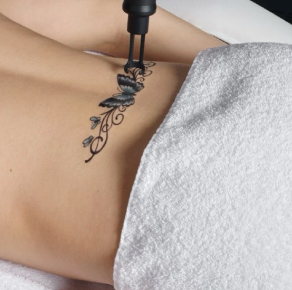 Laser Tattoo Removal - Medium Area at NICHÉ in Lewisville, TX