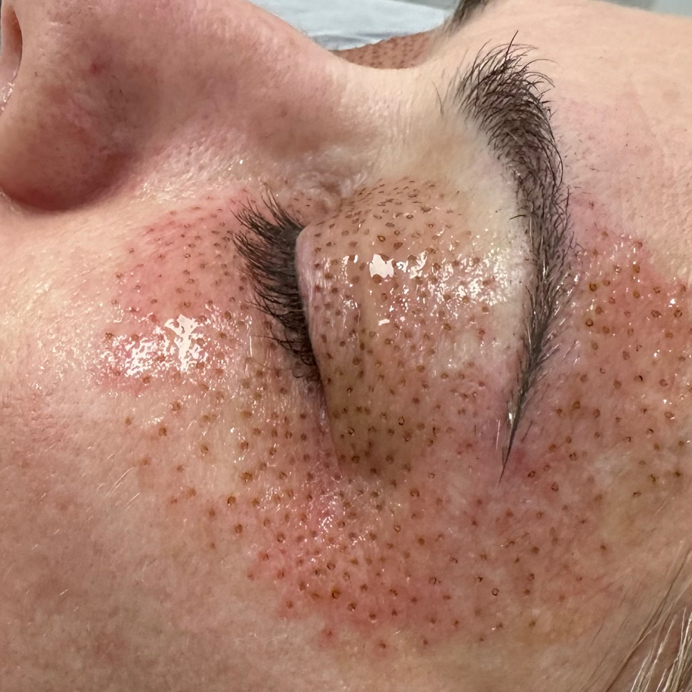 Combo Eyelids Groupon Voucher