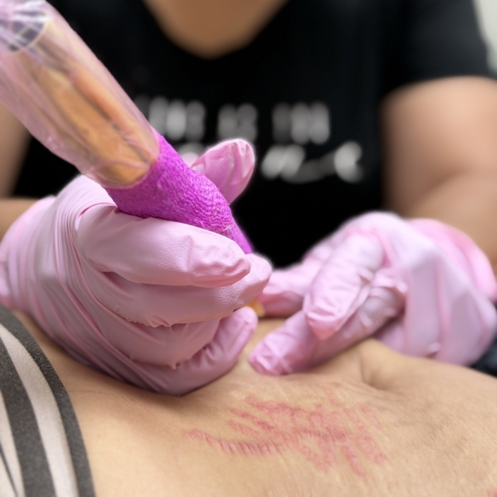 Inkless Stretch Mark Revision at Rooted Rituals Esthetics Co. in North Ogden, UT