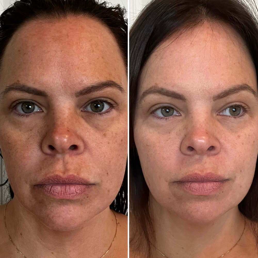 Carboxy Oxygen Facial at Amethyst | The Head Spa in Shreveport, LA