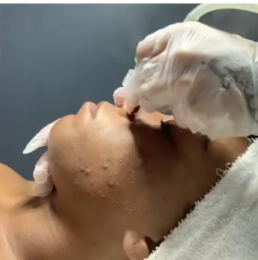 Microdermabrasion